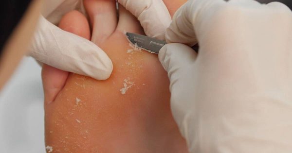 Callus treatment intensive